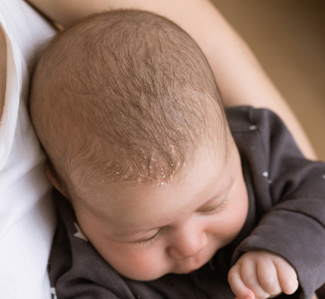 Затылок у малышей. Корочки на голове у новорожденнн. Корочки на голове у новорожденного.