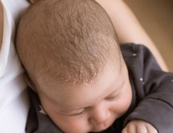 Baby Cradle Cap - Baby Child